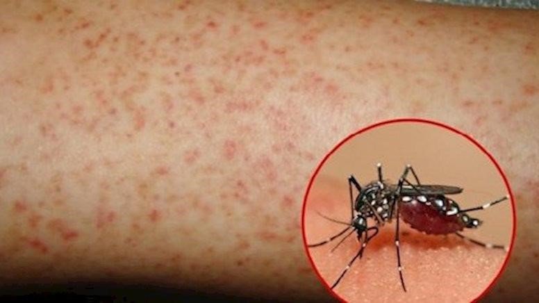 Sốt virus và sốt xuất huyết: cách phân biệt và phòng tránh
